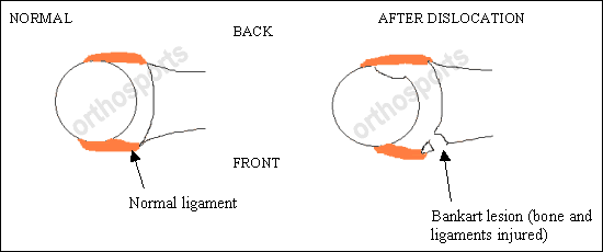 Shoulder Instability