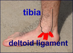 deltoid ligament ankle sprain