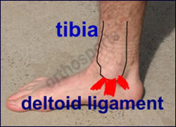 torn deltoid ligament