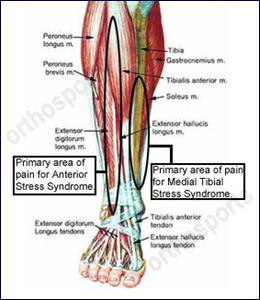 Exercise Related Shin Pain, Shin Splints. Orthosports