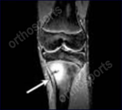 Exercise Related Shin Pain, Shin Splints. Orthosports