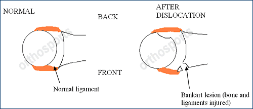 sm shoulder instability