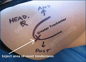 https://orthosports.com.au/wp-content/uploads/2019/11/troch-bursitis.jpg