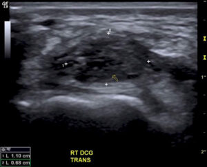 Ultrasound showing wrist ganglion