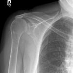 shoulder