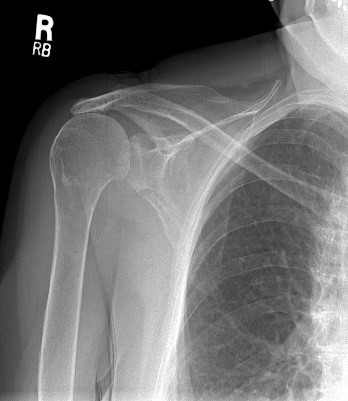 Massive Retracted Rotator Cuff Tear