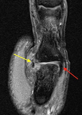 ulnar collateral ligament wrist mri