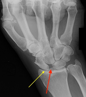 Scapholunate ligament injury - Melbourne Hand Surgery