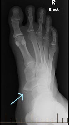 Accessory Bones of the Foot and Ankle - Orthosports