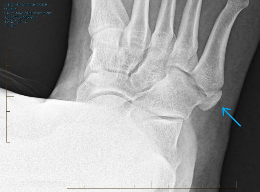 Accessory Bones of the Foot and Ankle - Orthosports