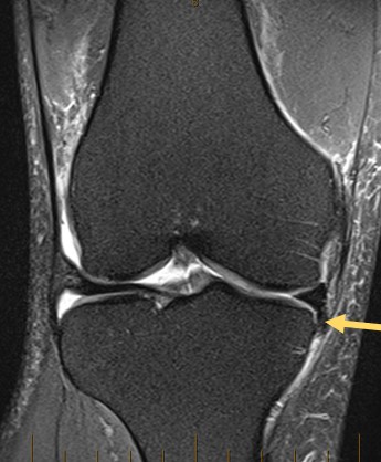 Displaced flap tears of the medial meniscus - Orthosports