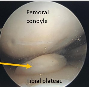 right knee medial meniscus posterior horn tear icd 10