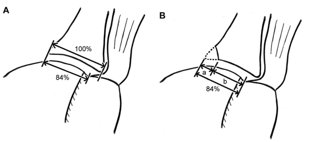 Glenoid Track and Shoulder Instability - Orthosports