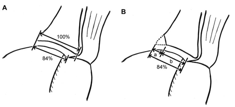 Glenoid Track and Shoulder Instability - Orthosports